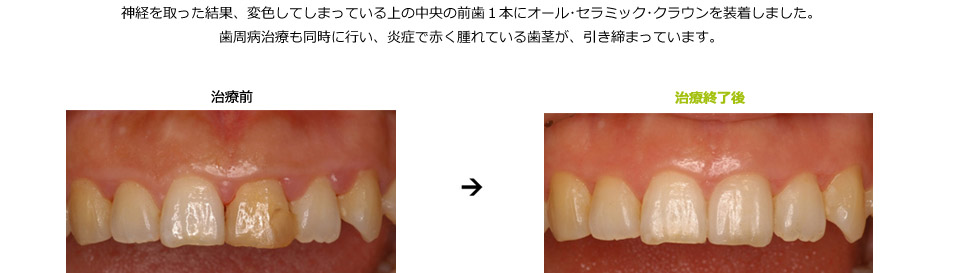 上の前歯の色の不調和と歯茎の炎症を改善