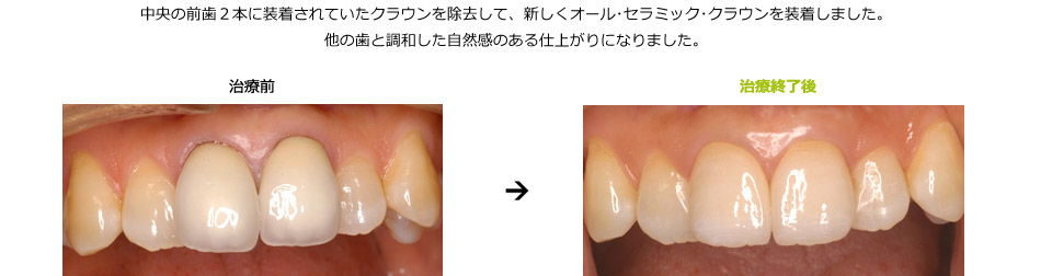 上の前歯の色の不調和を審美
