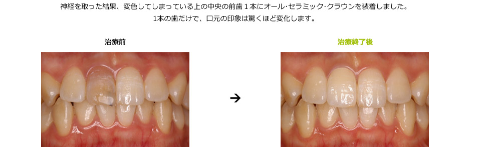 上の前歯の色の不調和を審美