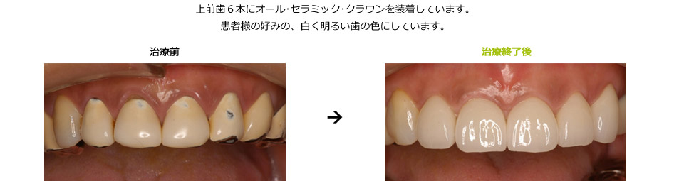 上の前歯の色の不調和を審美