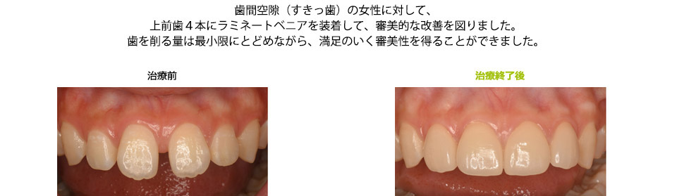 間隙のある前歯をラミネート･ベニアで審美