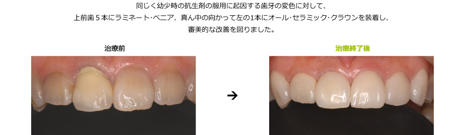 変色した前歯をラミネート･ベニアとオール･セラミック･クラウンで審美