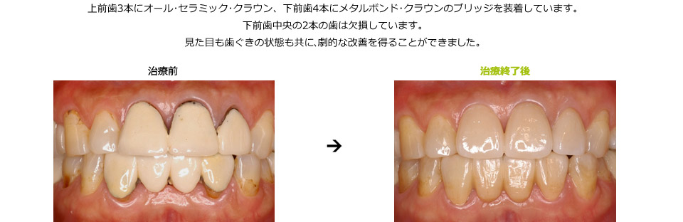上下の前歯を審美