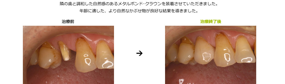 小臼歯にメタルボンドクラウンを装着