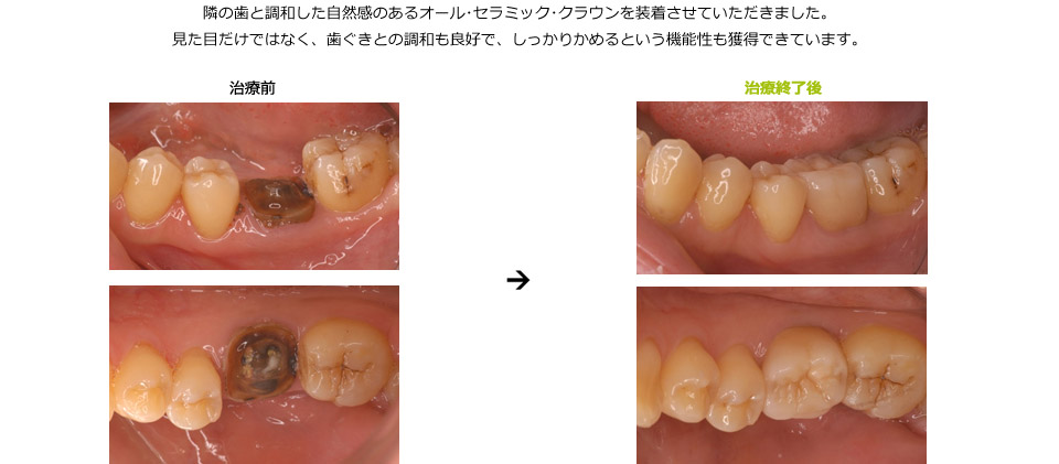 大臼歯にオール･セラミック･クラウンを装着