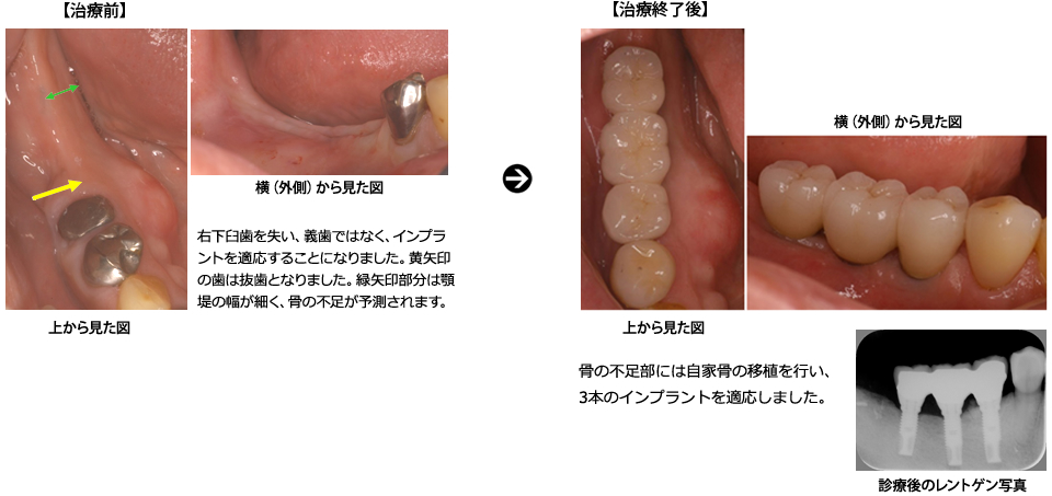 右下臼歯部へのインプラント適応
