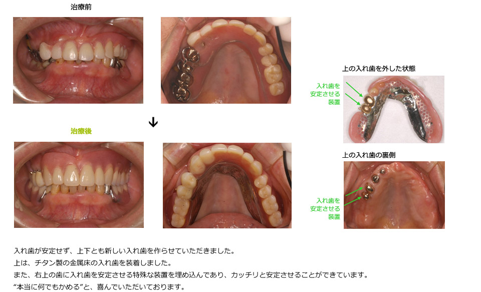 特殊な金属床義歯を装着し、機能的、審美的に改善