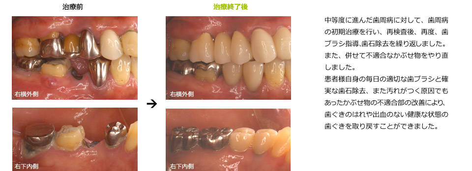 中等度の歯周病の治癒例