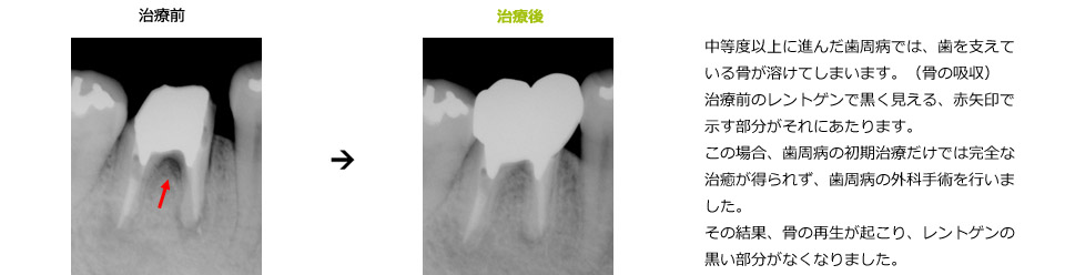 中等度の歯周病の治癒例