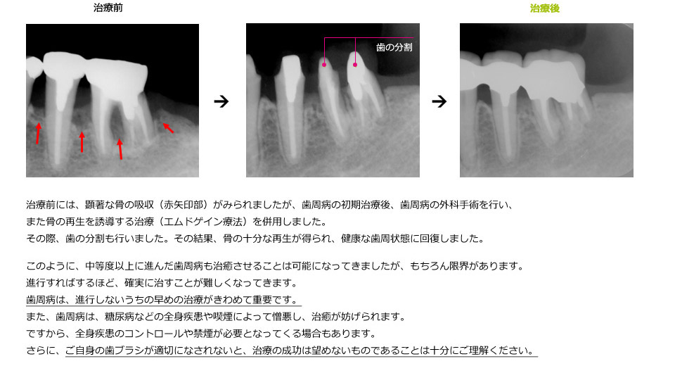 中等度の歯周病の治癒例
